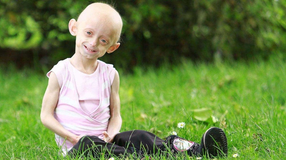progeria-erken-yaslanma-hastaligi.jpg