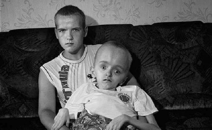 Çernobil Kurbanı Bir Çocuk