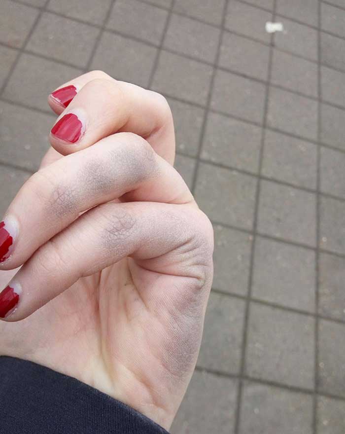 Solak Insanlari Huzne Bogan Bas Belasi Problemler 22