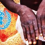 DSÖ Maymun Çiçeği Vakalarında Artış Bekliyor