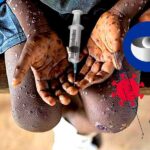 Avrupa İlaç Ajansı Maymun Çiçeği için Aşı Önerdi