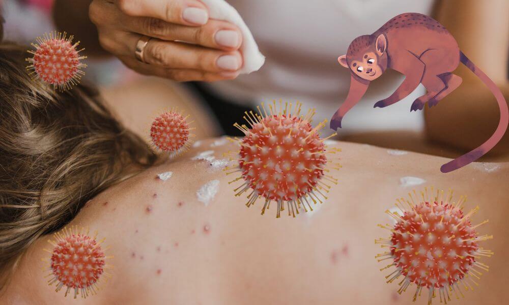 DSÖ: Maymun Çiçeği için Küresel Acil Durum Kararı