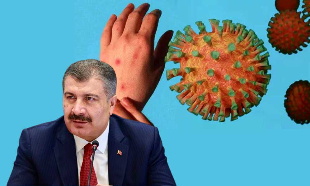 Sağlık Bakanı Duyurdu: Maymun Çiçeği Vakası Artıyor!